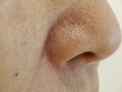 治療後（1年6ヵ月）